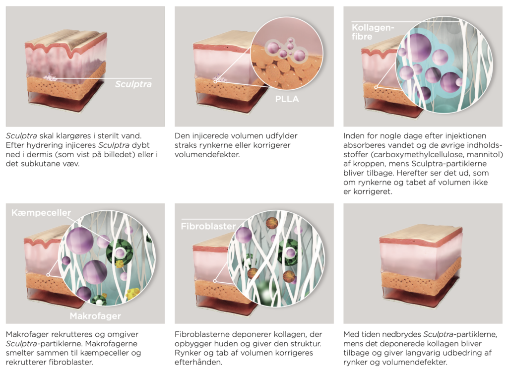 kollagenproduktion stimuleres Sculptra